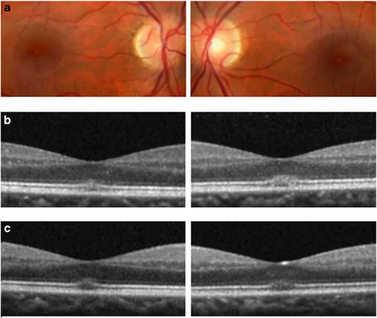 Three rows of retinal images from one patient: colour fundus photographs of both eyes showing yellow spots at the fovea, and two rows of optical coherence tomography scans showing disruption of the photoreceptor layer.